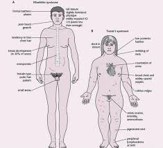 hypogonadism