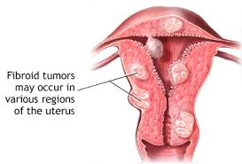 fibroid symptoms