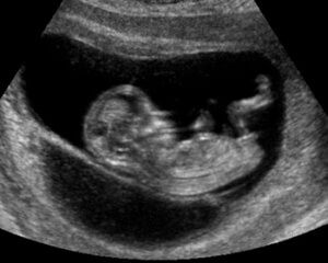 ultrasound 12 weeks